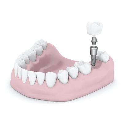 dental implant with screw post illustration