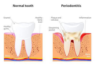 A healthy tooth and a tooth with periodontal disease