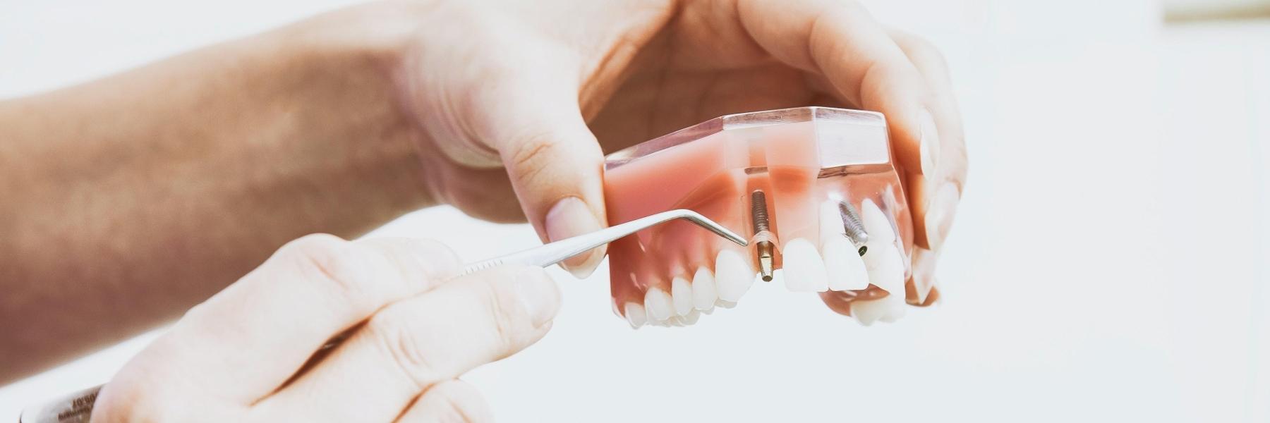 Dental Implant model