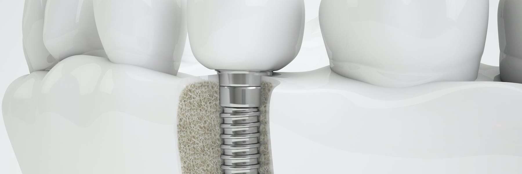 Diagram of a dental implant in Baton Rouge
