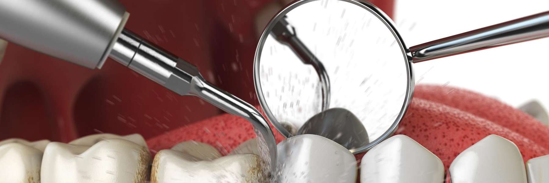 Diagram of teeth cleaning in Prairieville