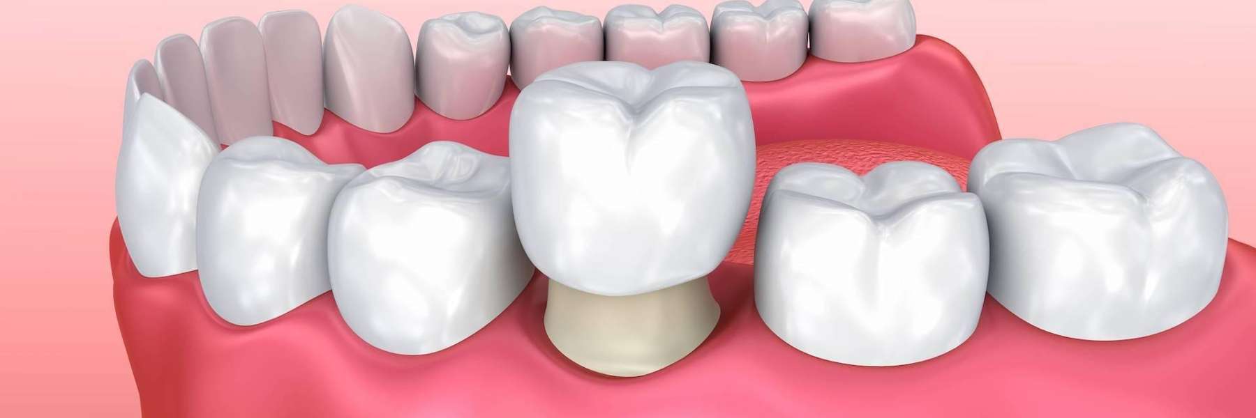 An illustration of a dental crown | Prairieville dentist