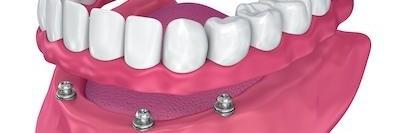Diagram of how implant dentures work at our Prairieville office