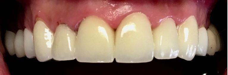 smile with dental crowns | Dental Crowns in Prairieville LA | Palm Family Dentistry