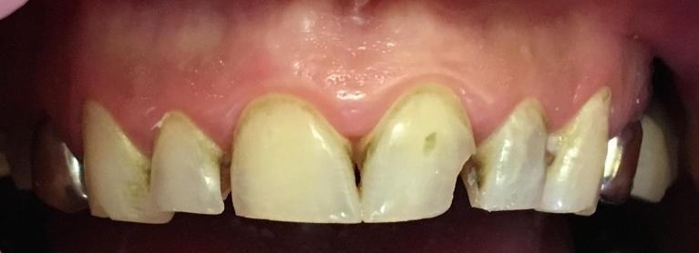 worn and broken teeth | Dental Crowns in Prairieville LA | Palm Family Dentistry