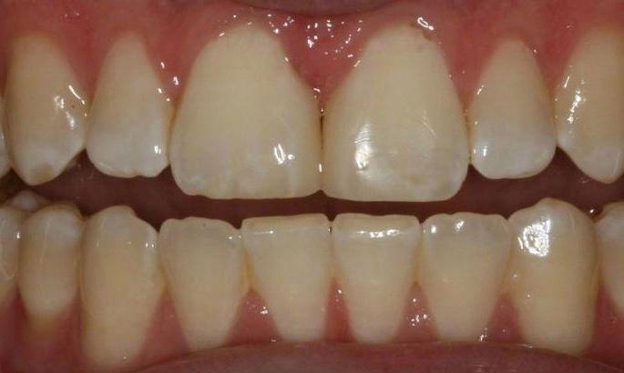 Diastema-Treatment-After-Image