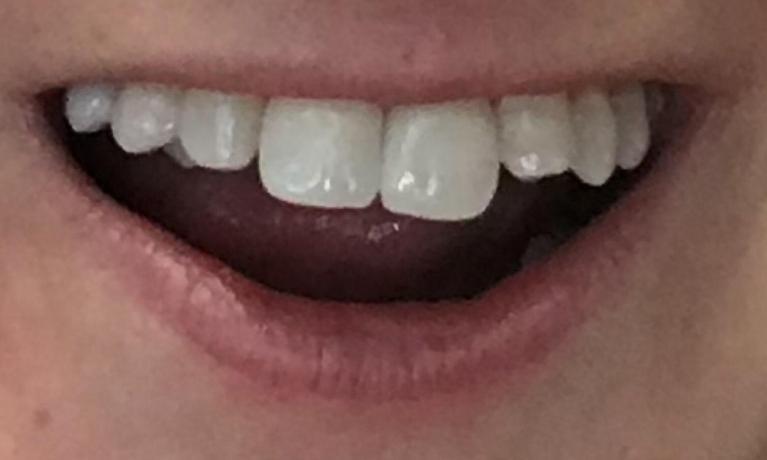 Bonding-and-Reshaping-Before-Image