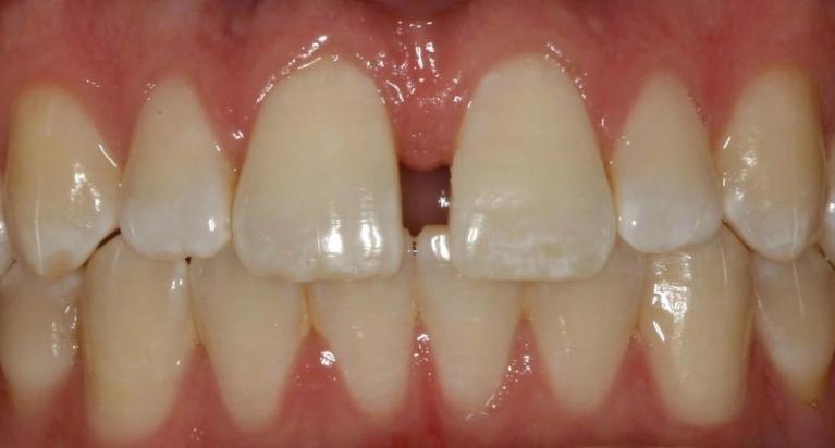 Diastema-Treatment-Before-Image